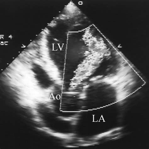 Transthoracic echocardiography (TTE). (a) Preoperative TTE shows an... | Download Scientific Diagram