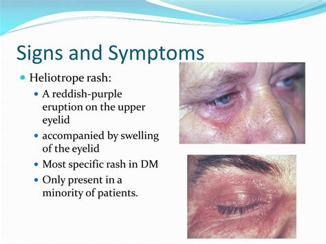 PPT - Dermatomyositis PowerPoint Presentation, free download - ID:5103882