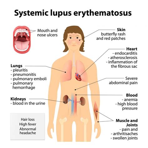 Lupus Symptoms in Women: Causes, Diagnosis and Treatment