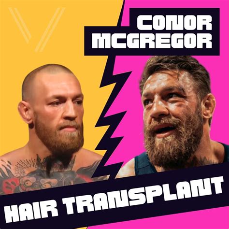 8+ Conor Mcgregor Hair Transplant - JordyneEmira