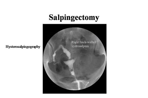 Salpingectomy Part 2 | Slides | GLOWM