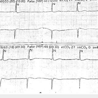 EKG rhythm strips show normal sinus rhythm in the lower strip and... | Download Scientific Diagram