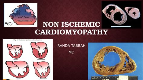 (PDF) Non ischemic cardiomyopathy