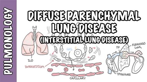 Interstitial Lung Disease (ILD) - Classification, pathophysiology ...