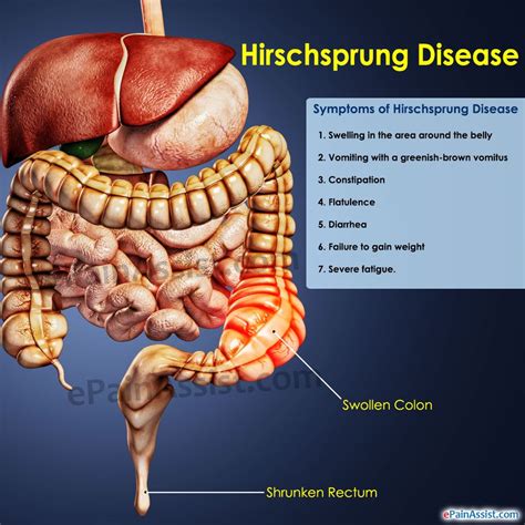 Enfermedad de Hirschsprung: causas, síntomas, diagnóstico, tratamiento - Niños-Salud 2024