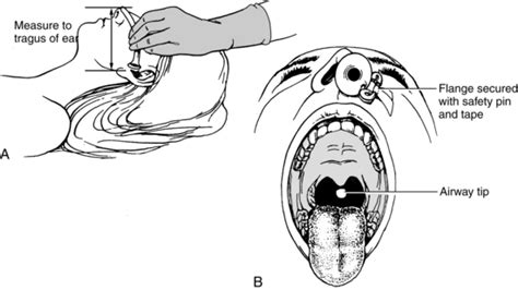 Nasopharyngeal Airway Sizing