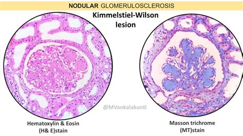 Diabetic Nephropathy - Pathology Made Simple