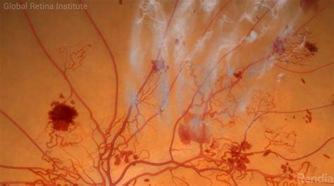 What is Proliferative Diabetic Retinopathy? - Global Retina Institute