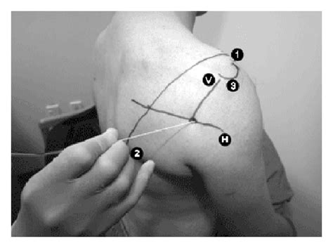 Price technique for the axillary nerve block. A line connects the ...