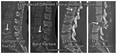 VirtualMedStudent.com || The Three Column Spine | Radiology schools, Spinal injury, Radiology