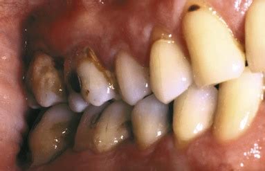 7: The Role of Dental Calculus and Other Local Predisposing Factors | Pocket Dentistry