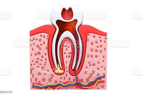 Tooth Decaycross Section3d Illustration Stock Photo - Download Image ...