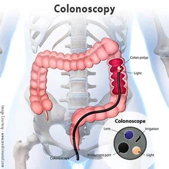 What is a Colonoscopy? Why is it done? Kauvery Blog