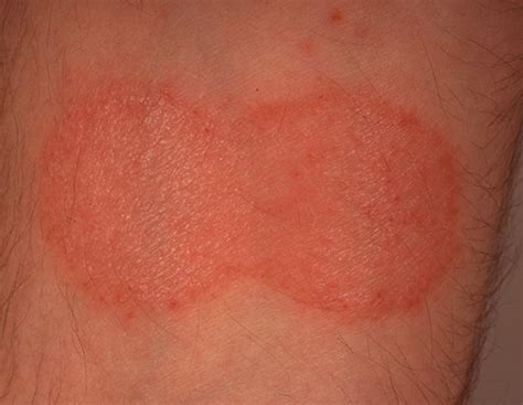 Mycosis Fungoides - Pictures, Staging, Symptoms, Treatment and Causes | hubpages