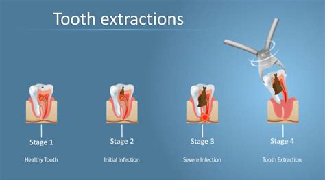 Tooth Extraction | Book An Appointment | Bellevue Dentist