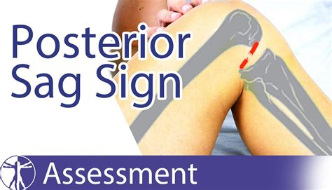 POSTERIOR SAG SIGN FOR PCL TEARS | POSTERIOR SAG SIGN FOR PCL TEARS Let ...