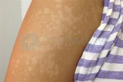 White Spots On Skin: 7 Causes & How To Get Rid of Them - Tua Saúde