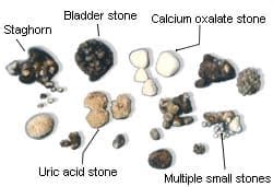 Types Of Kidney Stones