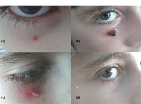 Pyogenic Granuloma Eye Treatment