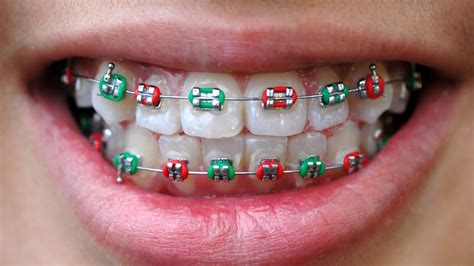 Beautiful Braces Colors | Dubai | Queens Medical Center