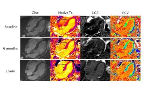 Advanced MRI benefits patients with heart stiffening disease | UCL News - UCL – University ...