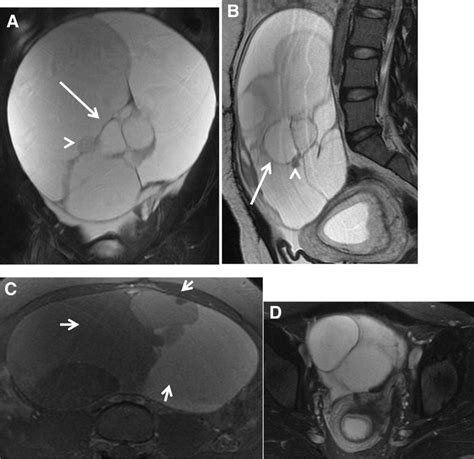 Recurrent mucinous borderline tumor. 27-year-old female at 10 weeks ...