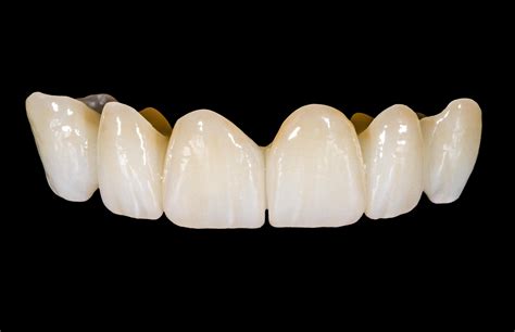 What is a Zirconia Crown? - Arc Dental