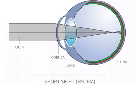 What is short-sightedness or myopia? - The Wimpole Eye Clinic