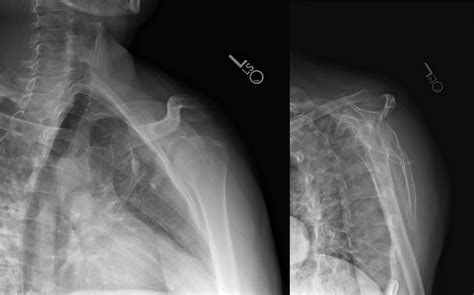 Treating Glenoid Fractures - Cancer Therapy Advisor