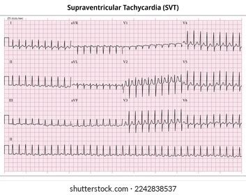 Supraventricular Tachycardia Ecg