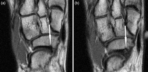 Imaging of tarsal navicular stress injury with a focus on MRI: A pictorial essay - Harris - 2016 ...