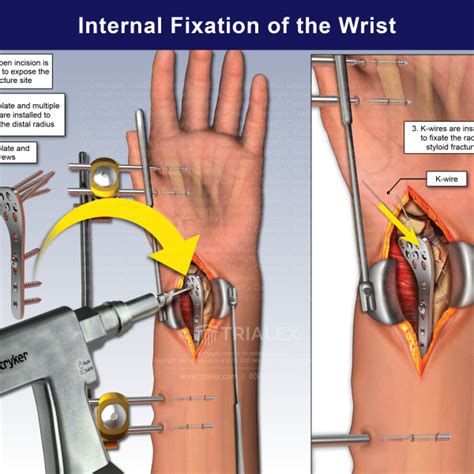 Internal Fixation of the Wrist - TrialExhibits Inc.