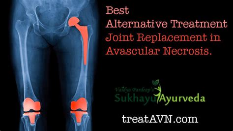 Choosing Best Alternative Treatments of Total Hip Replacement - Treat AVN