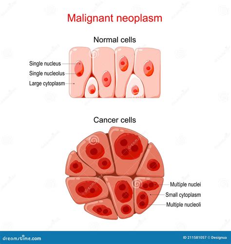 Malignant Neoplasm, Metastases On Mobile App Onboarding Screens. UI UX ...