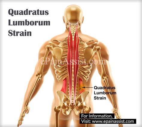 Quadratus Lumborum Strain|Causes|Symptoms|Treatment