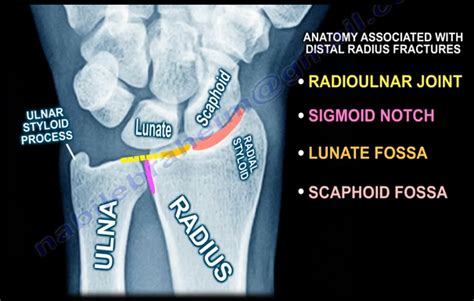 Common Types of Distal Radius Fractures | by Nabil Ebraheim | Medium