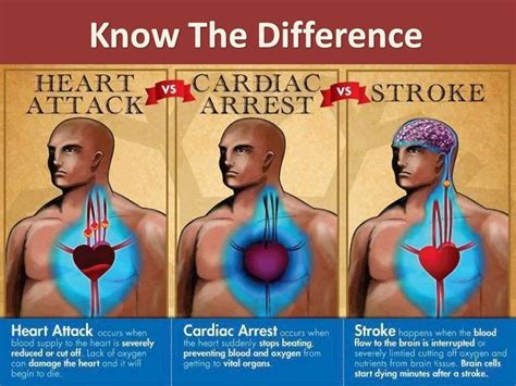 "Do you know the difference between a cardiac arrest and a stroke??? Share this important ...