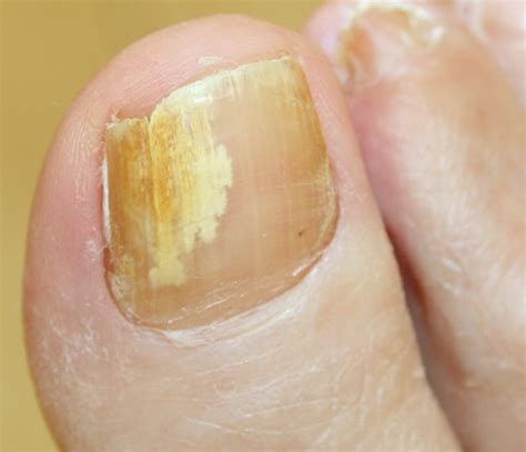 Yellow Toenails - Symptoms, Causes, Treatment, Pictures