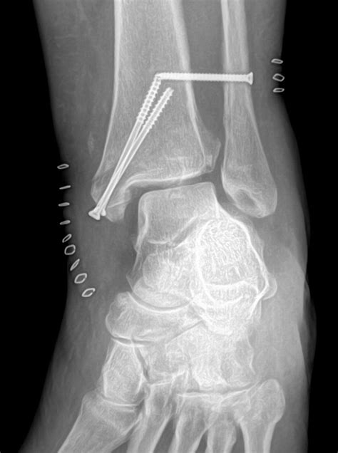 Forensics 101: Victim ID Based On Antemortem Fractures — Skeleton Keys