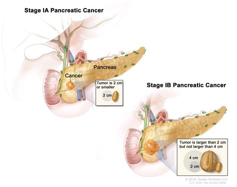 Pancreatic Cancer Treatment - NCI