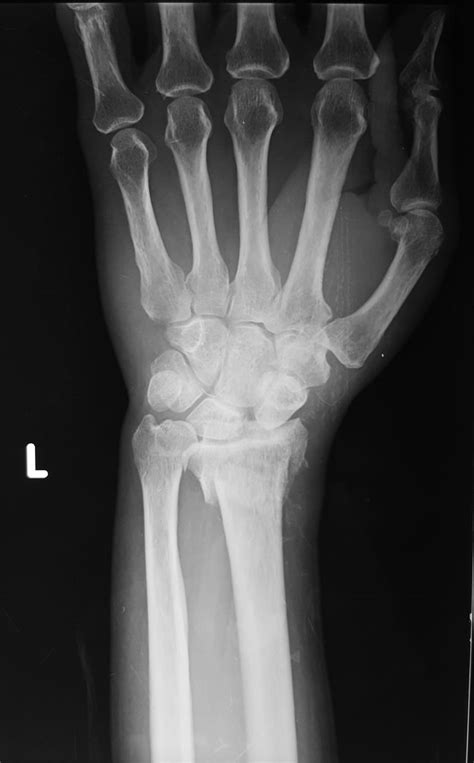 smith fracture, what to know?