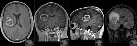 Glioblastoma