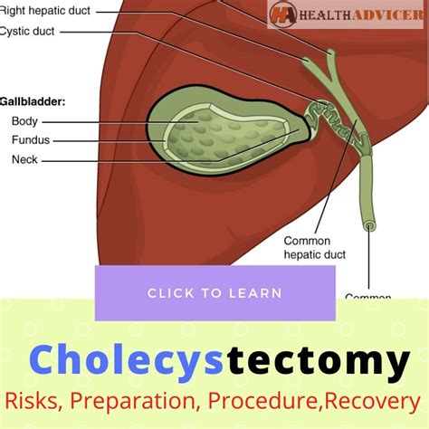 Cholecystectomy Anatomy