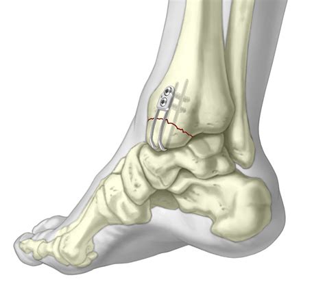 Medial Malleolar Sled - Lower Extremity Orthopedic Implant - TriMed Inc.