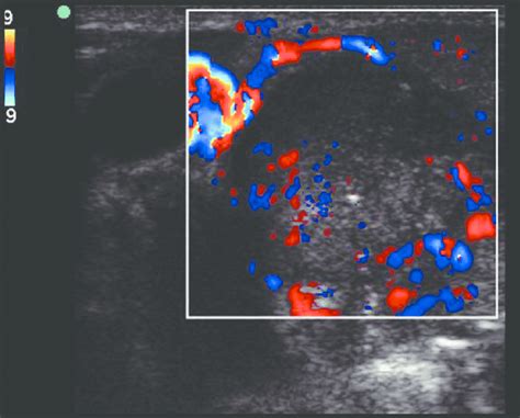 Inflamed Lymph Node Ultrasound