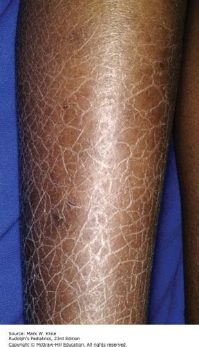 Ichthyosis Vulgaris Diagnosis | AccessMedicine Network