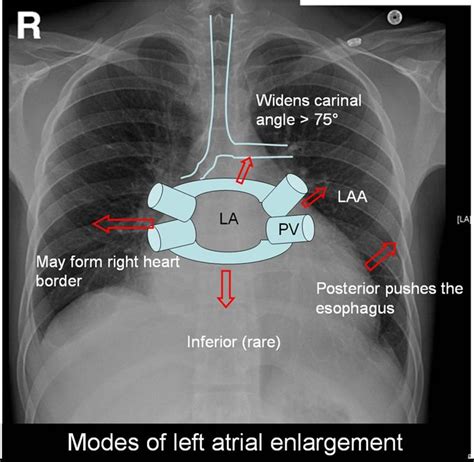 Image result for mitral stenosis xray