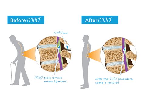 Free Hoovering: Pild Procedure For Spinal Stenosis