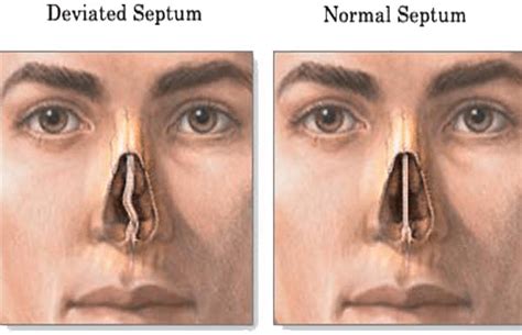 Rhinoplasty For a Deviated Septum | Westside Head & Neck