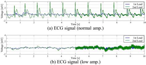 Morphology-matching-based R-wave detection for noise-robust ECG gating | Journal of ...